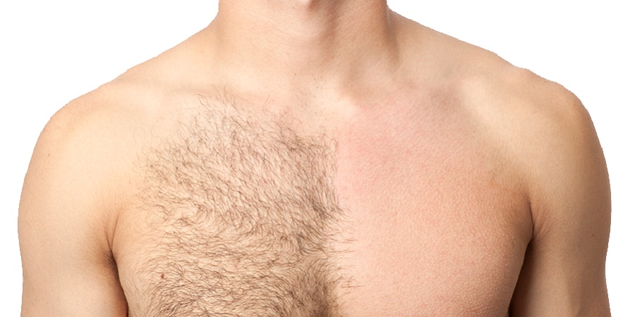 y/از بین بردن موهای زائد بدن مردان